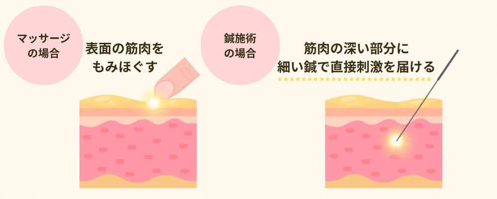 マッサージは表面の筋肉をもみほぐし、鍼施術は筋肉の深い部分に細い鍼で直接刺激を届けるというアプローチの違いを示した図